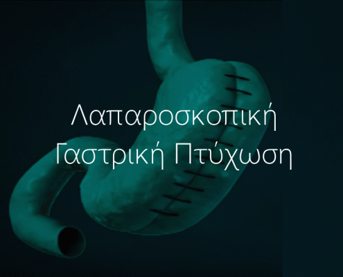 γαστρικο μανικι γαστρικο bypass πτυχωση