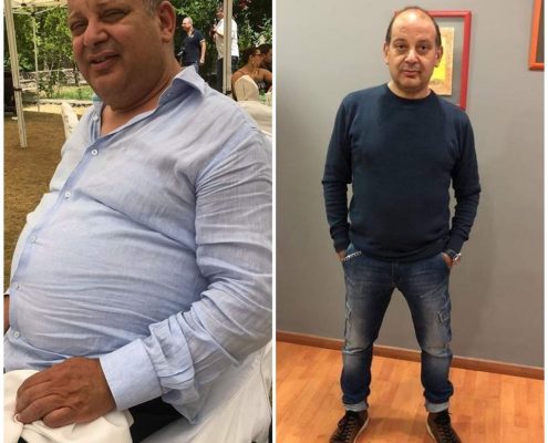 γαστρικο μανικι επεμβαση παχυσαρκιας