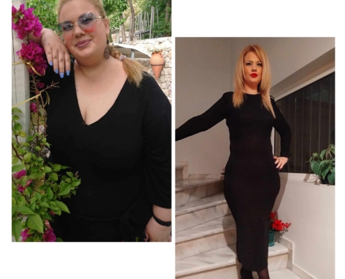 Παχυσαρρκία
