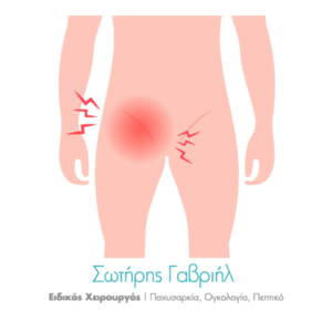 βουβωνοκήλη πόνος, κήλη των αθλητών 