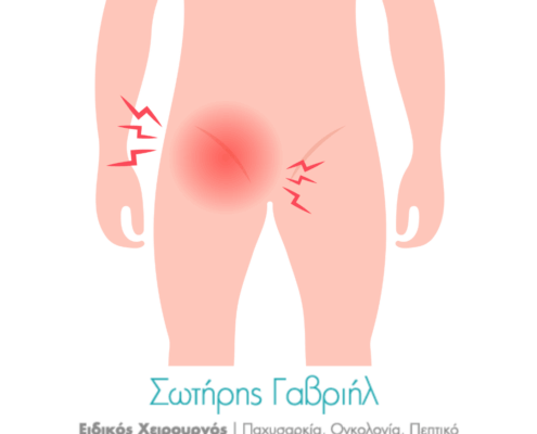 βουβωνοκήλη πόνος, κήλη των αθλητών