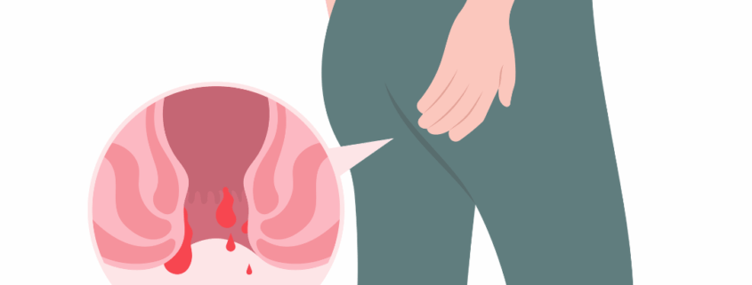 αιμορροΐδες είδη