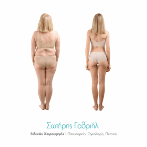 σταθεροποίηση βάρους μετά το γαστρικό μπότοξ 