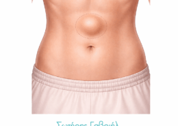 κήλη λευκής γραμμής