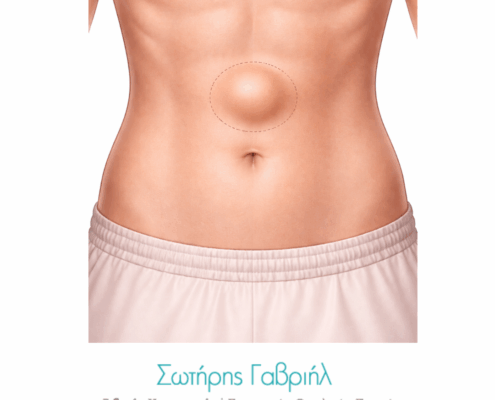 κήλη λευκής γραμμής