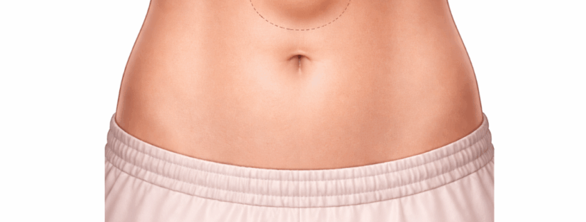 κήλη λευκής γραμμής