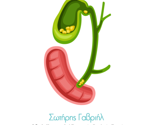 πολύποδες στη χολή