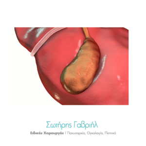 καρκίνος χοληδόχου κύστης