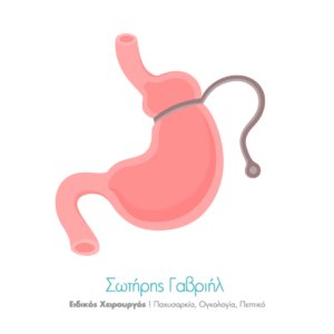 Γαστρικός δακτύλιος γαστρικό μανίκι