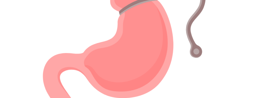 Γαστρικός δακτύλιος γαστρικό μανίκι