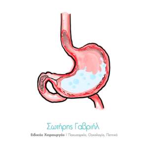 γαστροοισοφαγική παλινδρόμηση βήχας