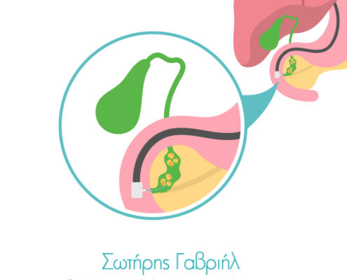 χολοκυστίτιδα