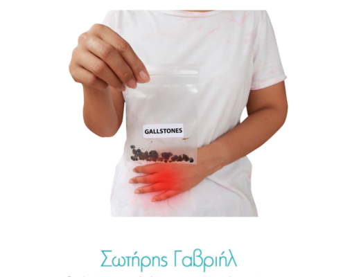 χολολιθίαση