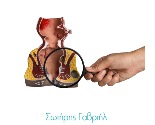 αιμορροΐδες